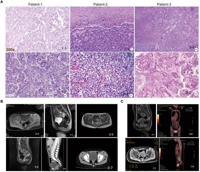 Genetic alterations in juvenile cervical clear cell adenocarcinoma unrelated to human papillomavirus